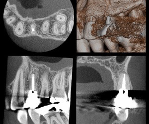 歯科用CT